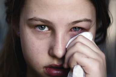 Keep an eye out for conjunctivitis