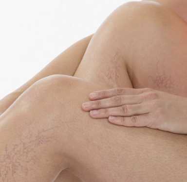 There is help for varicose veins!
