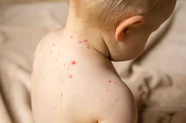 Decoding Your Baby's Rash