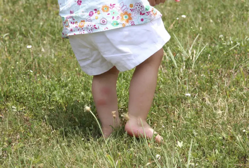 bug bites on a child's leg