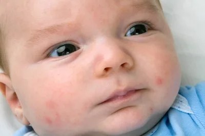 Baby with rash