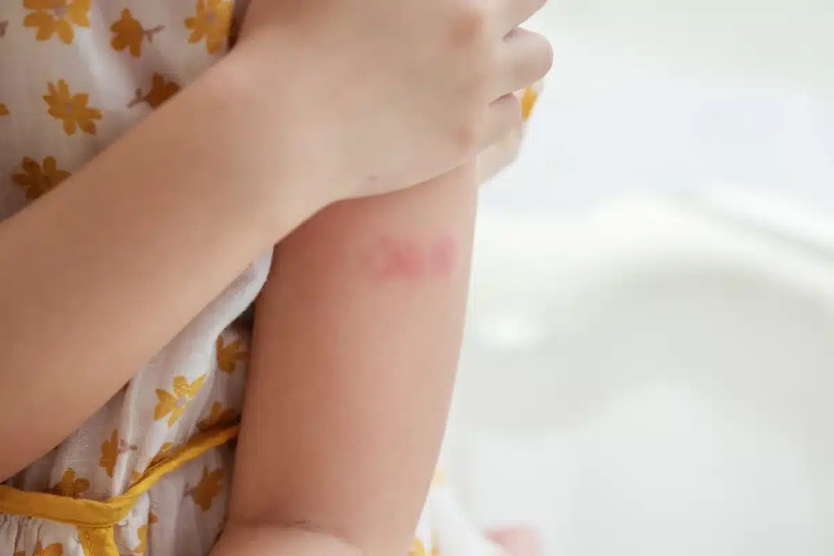 Little girl has skin rash allergy itching and scratching on her arm